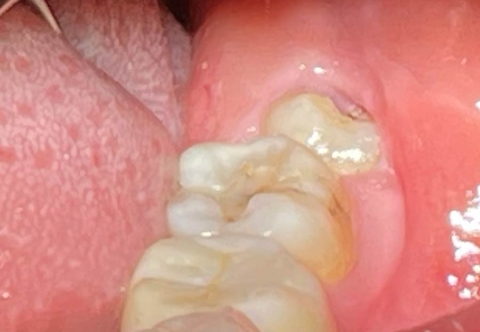 Thời gian nhổ răng khôn là bao nhiêu? Bao lâu thì lành thương 